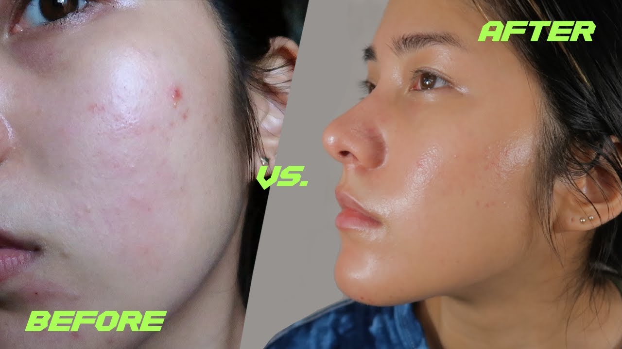 How I Cleared My Acne & Hyperpigmentation | My Differin Experience | YesStyle Skincare Haul