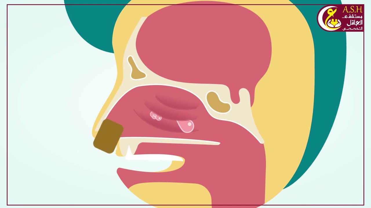 تضخم لحمية البلعوم الأنفي لدى الأطفال