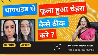 थायराइड से फूला हुआ चेहरा कैसे ठीक करे  (Puffyface/face swelling) by Dr Tanvi Mayur Patel