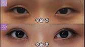 라리성형외과의 눈꼬리내리는수술은 ? - YouTube 라리성형외과의 눈꼬리내리는수술은 ? - Youtube
