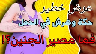 عرض خطير.. الحساسية أو الحكة أو الهرش في الحمل.. مصير الجنين مؤسف في هذه الحالة