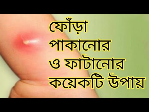 ভিডিও: স্কুইড ফোঁড়া কিভাবে