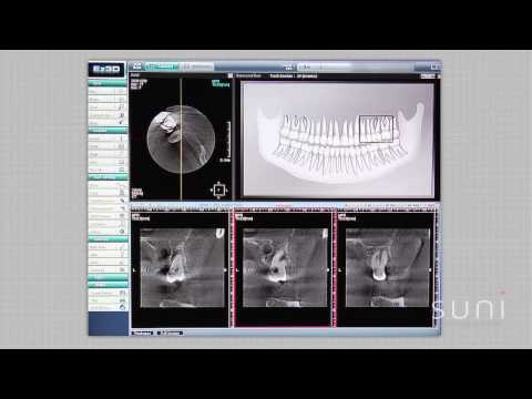 Suni Case Study 3: Vertical Fracture/Root Resection