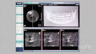 Suni Case Study 3: Vertical Fracture/Root Resection