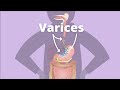 Cirrhosis Varices 
