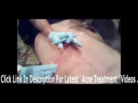 acne treatment at home    Biggest Zit Cyst Pop Ever Best   squeeze acne horror