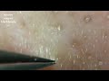 鼻角栓120.2nose blackheads(larger version)★tweezerz only★