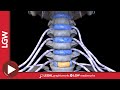 Anterior Cervical Discectomy and Fusion with Herniation 3D Animation