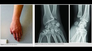Druj Dislocation Or Distal Radioulnar Joint Dislocation What Is It, Types Of Dislocation