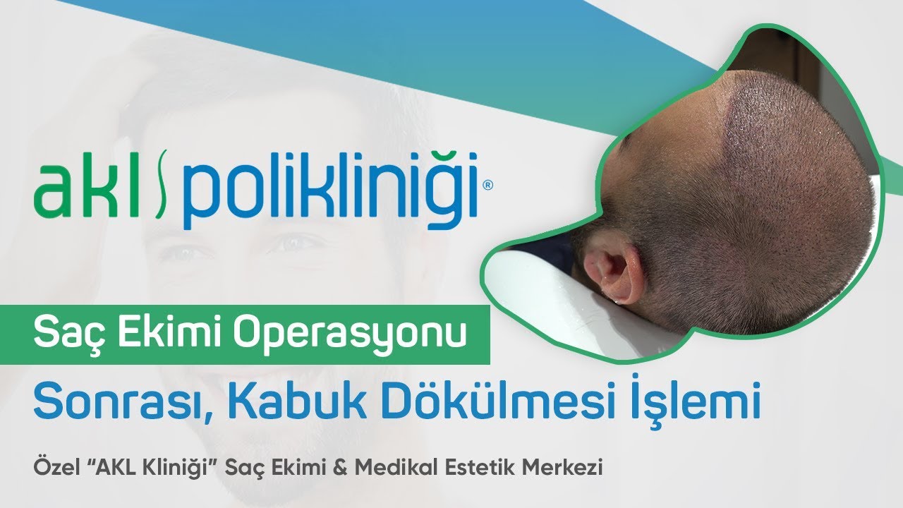 AKL Klinik | Saç Ekim Operasyonu Sonrası 10. Gün Yıkama (Kabuk Dökülmesi) #saçekimi #hairtransplant