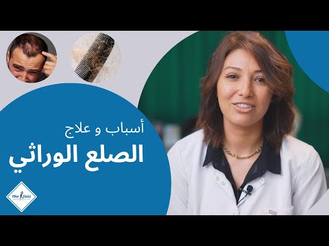      علاج الصلع الوراثي