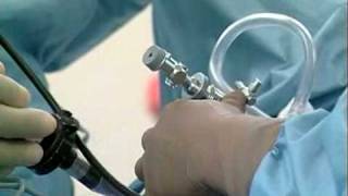 Vaginal Hysterectomy