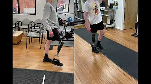 Ryan, an above the knee amputee trying out his new Ottobock X3 knee