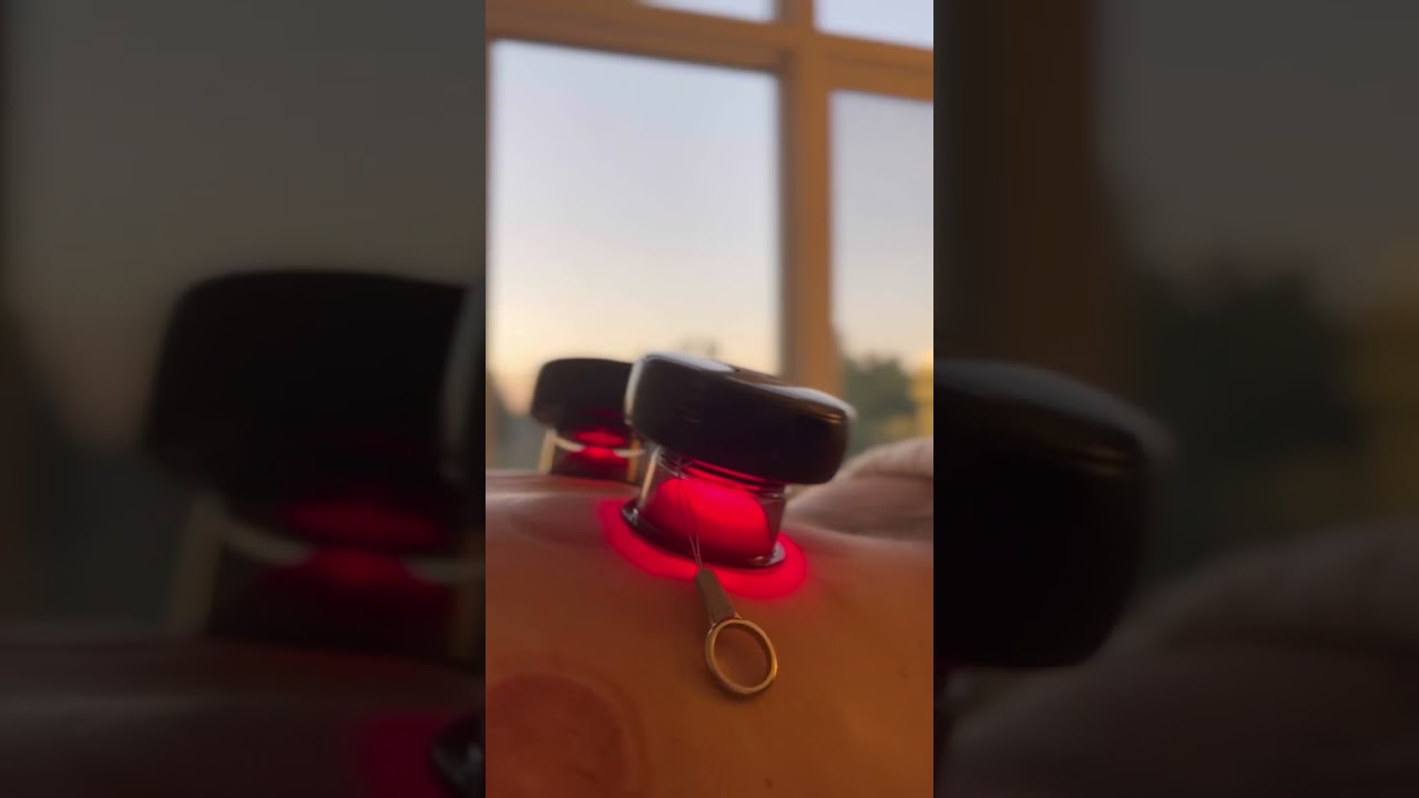 The art of cupping therapy 