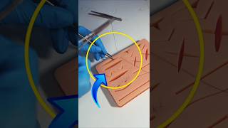 Surgical Suture Type
