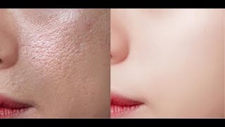Use this Night cream to remove sun tan from your skin & regain glow and its 100% natural