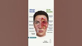 Allergic Rhinitis vs Acute Sinusitis — Know the Difference 🔥
