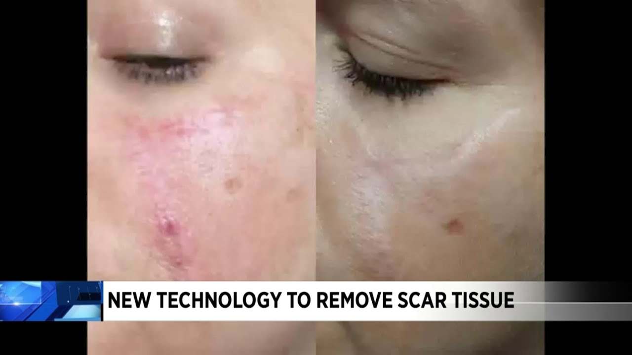 New technology to remove scar tissue comes to Roanoke