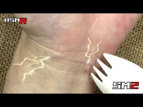 【眠くなってくるアトピー性皮膚炎ASMR】手首が痒すぎる！プラスチックフォークスプーンで掻く！/癒し/リラックス効果/睡眠導入/マッサージ