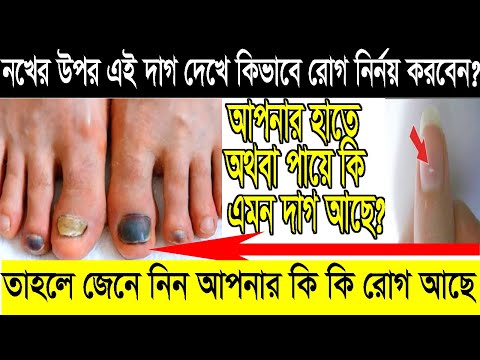 নখ ক ল দ গসহ আরও য সব লক ষণ ইঙ গ ত দ খ র গ ন র নয কর য য 