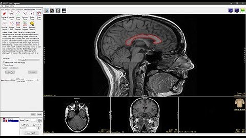 Analyze 15.0 - Segment: Smart Trace