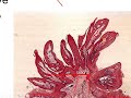 Benign Epithelial Neoplasms