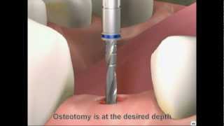 Drill stopper by dentalimplantsworld 3,459 views 13 years ago 28 seconds