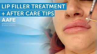 Lip Filler Tutorial + Comfortox Lips After Care