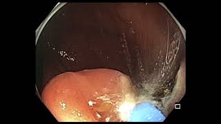 Colonoscopy: IC valve polyp