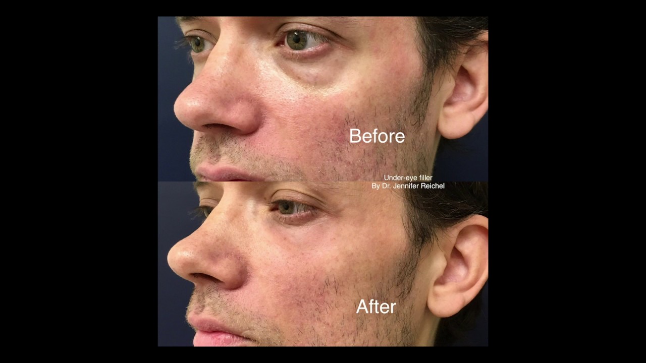 UnderEye Filler for Men Using Belotero, Dr. Jennifer Reichel, Seattle