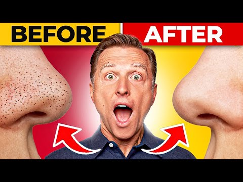 How To REMOVE Blackheads Permanently