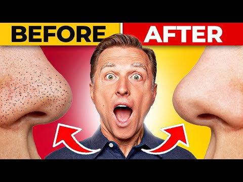 How To Remove Blackheads Permanently