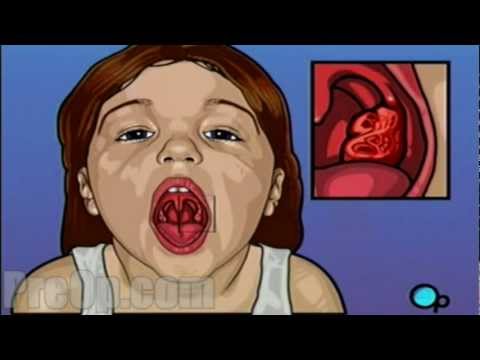 Video: Vai es varu noskalot kaklu pēc tonsillectomy?