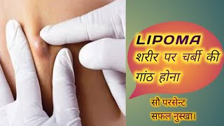 चर्बी की गाँठे (LIPOMA) को जड़ से खत्म करे 100% 