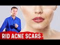 Best Way to Rid Acne Scars