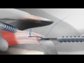 Rotator Cuff Repair with Arthrex® SutureBridge™