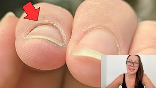 Why would skin separate from the nail. [Pro Nail Tech explains]