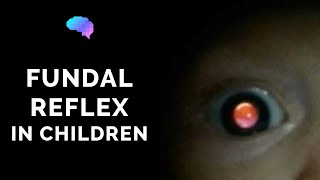 Fundal Reflex (a.k.a. Red Reflex) Assessment in Children - OSCE Guide | UKMLA | CPSA