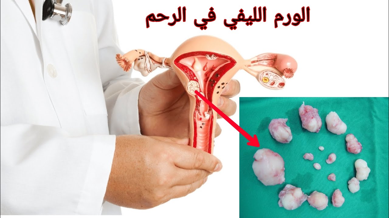 الورم الليفي السليم بالرحم fibroid   .. هل ممكن أن يتحول لسرطان ؟؟
