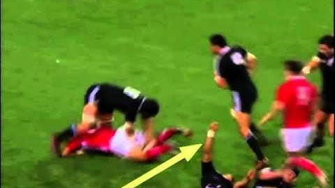 Example of tonic posturing following concussion