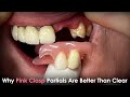 Why pink clasp partials are better than clear clasp partials