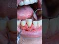 How a Loose Tooth is Saved 🦷 Dental Splinting Process Explained#LooseToot#DentalSplinting#DentalCae