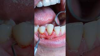 How a Loose Tooth is Saved 🦷 Dental Splinting Process Explained#LooseToot#DentalSplinting#DentalCae