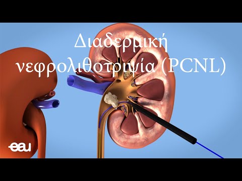 Αφαίρεση λίθων από τους νεφρούς – Διαδερμική νεφρολιθοτριψία (PCNL-GR)