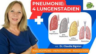 Pneumonia explained simply in 4 phases! | Dr. Claudia Bignion