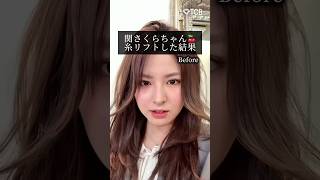 【糸リフト】関さくらちゃん🍒糸リフトした結果 #shorts