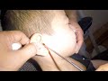 Removing Something DRY &amp; Stuck in Boy&#39;s EAR