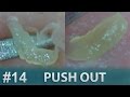 #14 Push Out(Squeezing)Blackheads Close up | ピンセットで角栓を押し出し除去