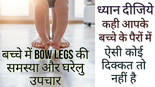 बच्चों के पैरों में Gap होने के- Symptoms, Reasons and Treatment | Bow Legs in Babies | Curve Legs