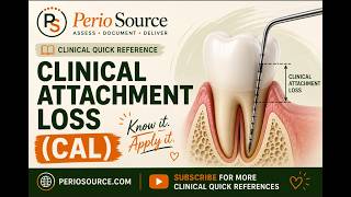 Clinical Attachment Loss (CAL) | PerioSource™ Clinical Quick Reference
